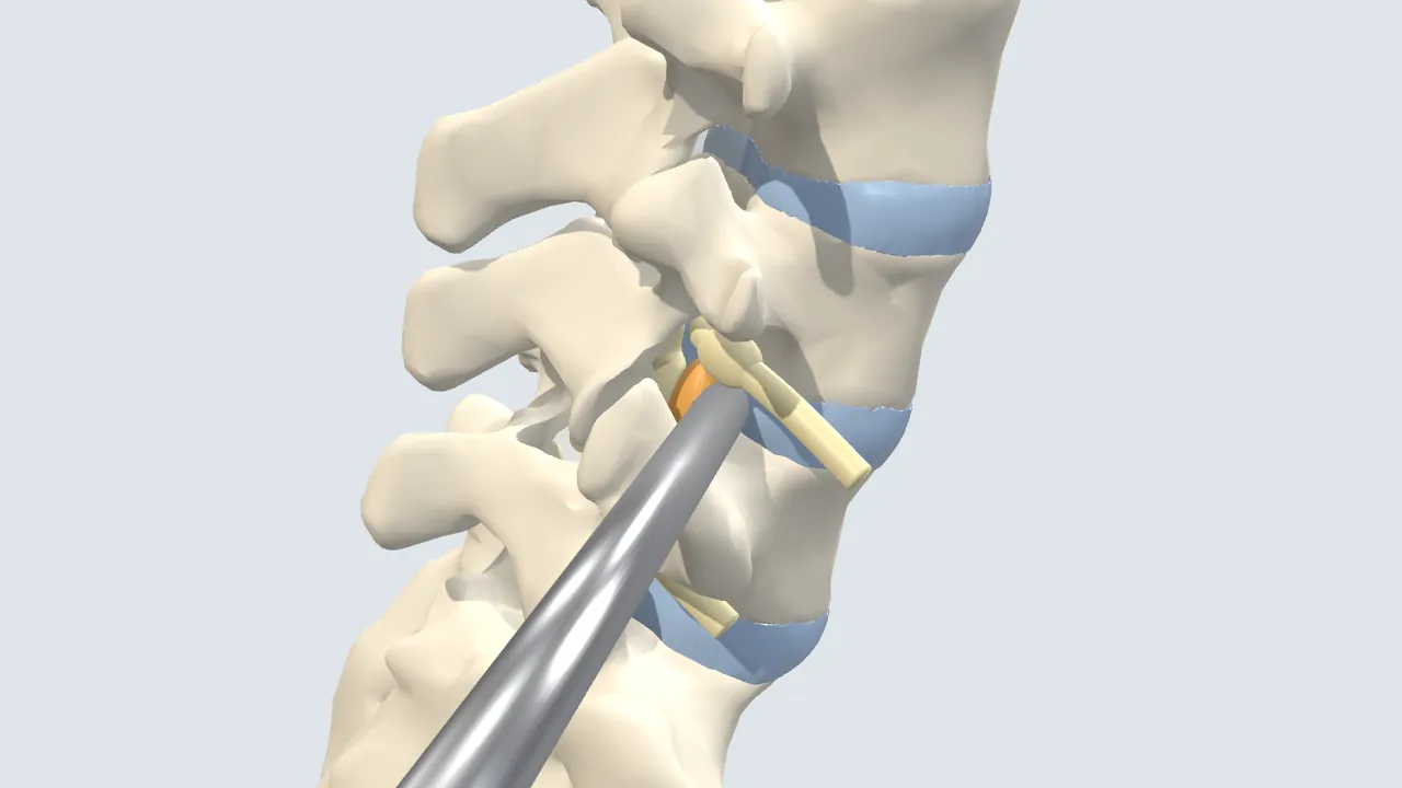 Illustration of the lower spine seen from the side and slightly behind, with a thin tube and endoscope passing through the opening beside the L4–L5 joint to reach a disc fragment next to the nerve root.